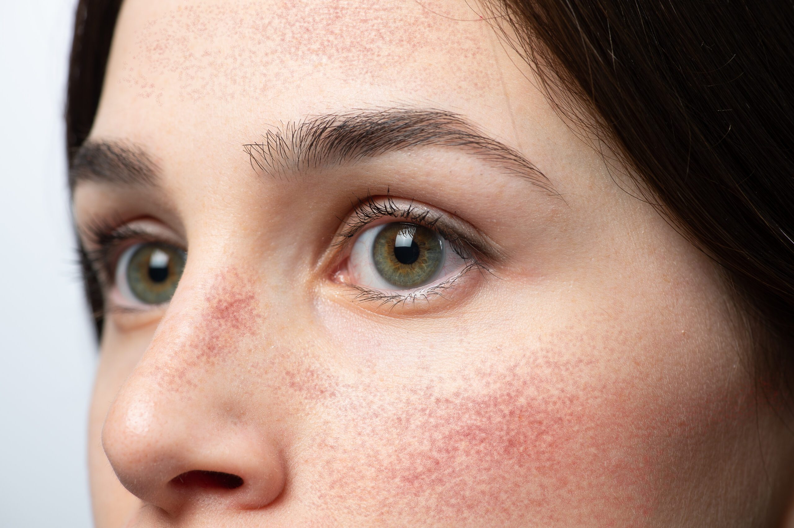 Face of a young woman with red cheeks suffering rosacea - by Dr. Tara O'Desky at The Rosacea Method .com
