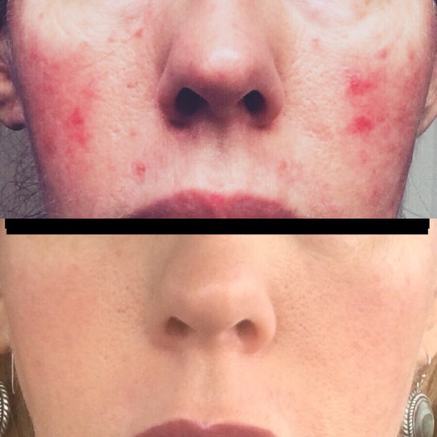 The Rosacea Method Before and After incorporating a rosacea diet female Image 5