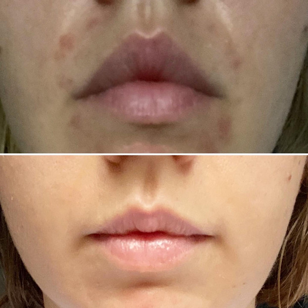 The Rosacea Method Before and After incorporating a rosacea diet female Image 6