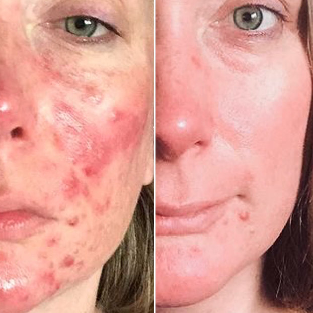 The Rosacea Method Before and After incorporating a rosacea diet female Image 4