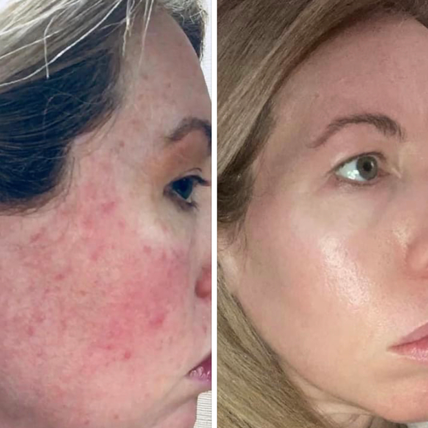The Rosacea Method Before and After incorporating a rosacea diet female Image 3
