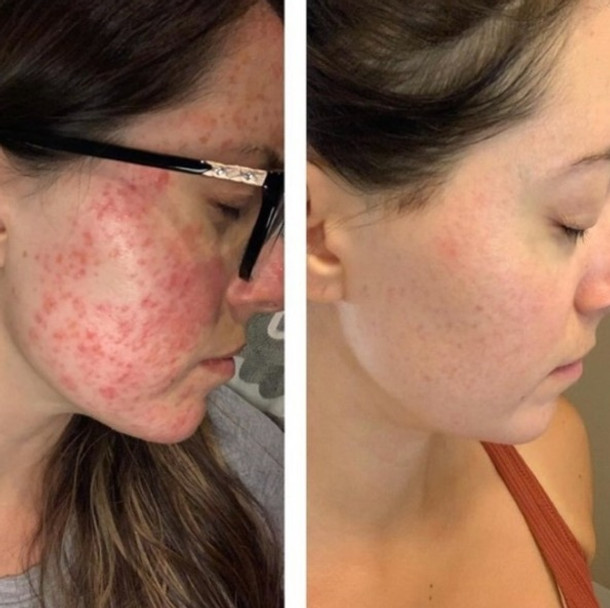 The Rosacea Method Before and After incorporating a rosacea diet female Image 2