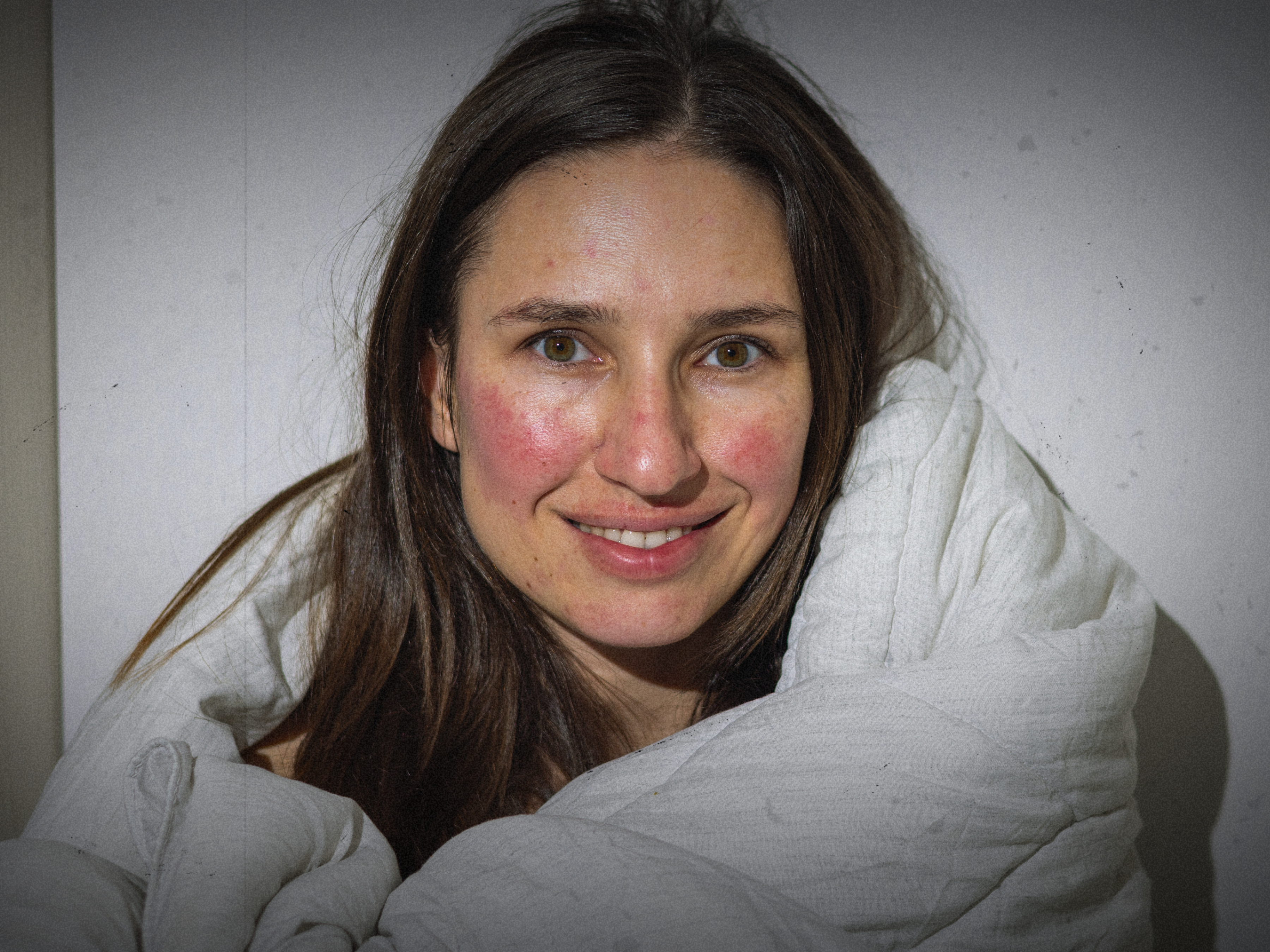 Woman smiling with Type 1 rosacea redness on the cheeks. How to Treat Flare-ups Naturally - The Rosacea Method - Dr. Tara O'Desky.