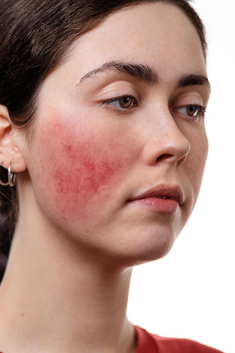Type 1 rosacea Erythematotelangiectatic Rosacea symptoms. Profile of woman's face showing red, inflamed, and veinous skin on the cheeks. The Rosacea Method - Dr. Tara Odesky