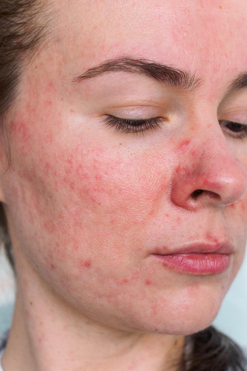 type 2 rosacea Papulopustular Rosacea symptoms. Profile of a woman's face showing acne-like pustules and papules along with red skin on her cheeks nose and chin. The Rosacea Method - Dr. Tara Odesky
