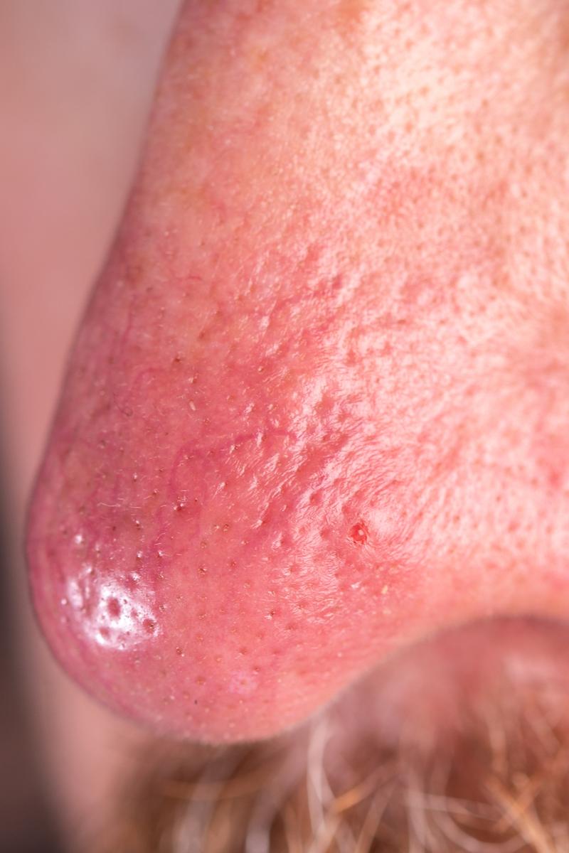 Type 3 rosacea Phytamous Rosacea symptoms. Close up of a man's nose showing inflamed, red, and thickened skin on his nose. The Rosacea Method - Dr. Tara Odesky