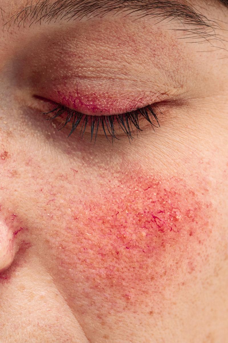 type 4 rosacea Ocular Rosacea symptoms. Close up of woman eye's and cheeks showing dry, red, inflamed skin on the eyelids and cheeks. - The Rosacea Method - Dr. Tara Odesky