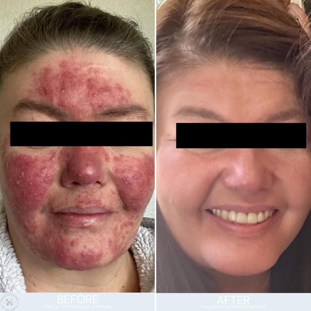 The Rosacea Method Client Transformation Results - woman with severe type 1 and 2 rosacea on the left and the same woman with a dramatic transformation of clear skin on the right