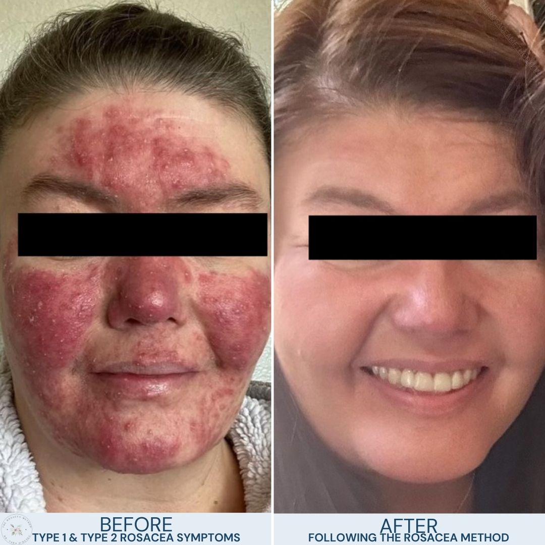 The Rosacea Method Client Transformation Results - woman with severe type 2 Papulopustular Rosacea on the left and the same woman with a smile and the dramatic transformation of clear skin on the right. Showing similar symptoms with. Papulopustular Rosacea vs Acne Vulgaris