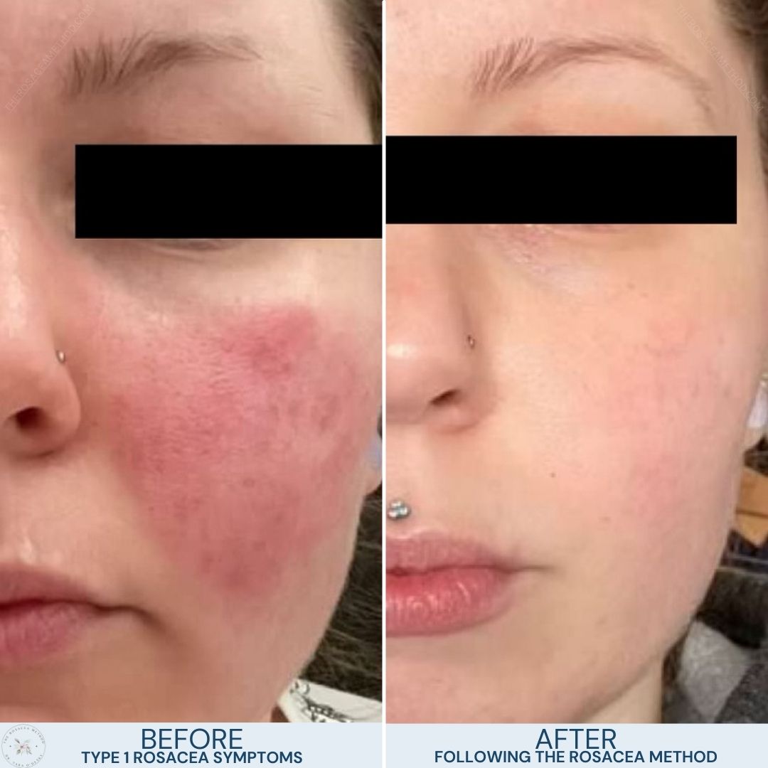 The Rosacea Method Client Transformation Results - woman with severe type 1 rosacea on the left and the same woman with a dramatic transformation of clear skin on the right