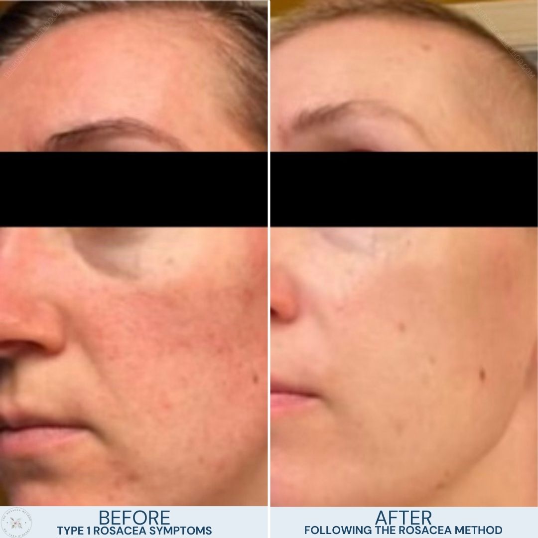 The Rosacea Method Client Transformation Results - woman with mild type 1 rosacea on the left and the same woman with a smile and the wonderful transformation of clear skin on the right