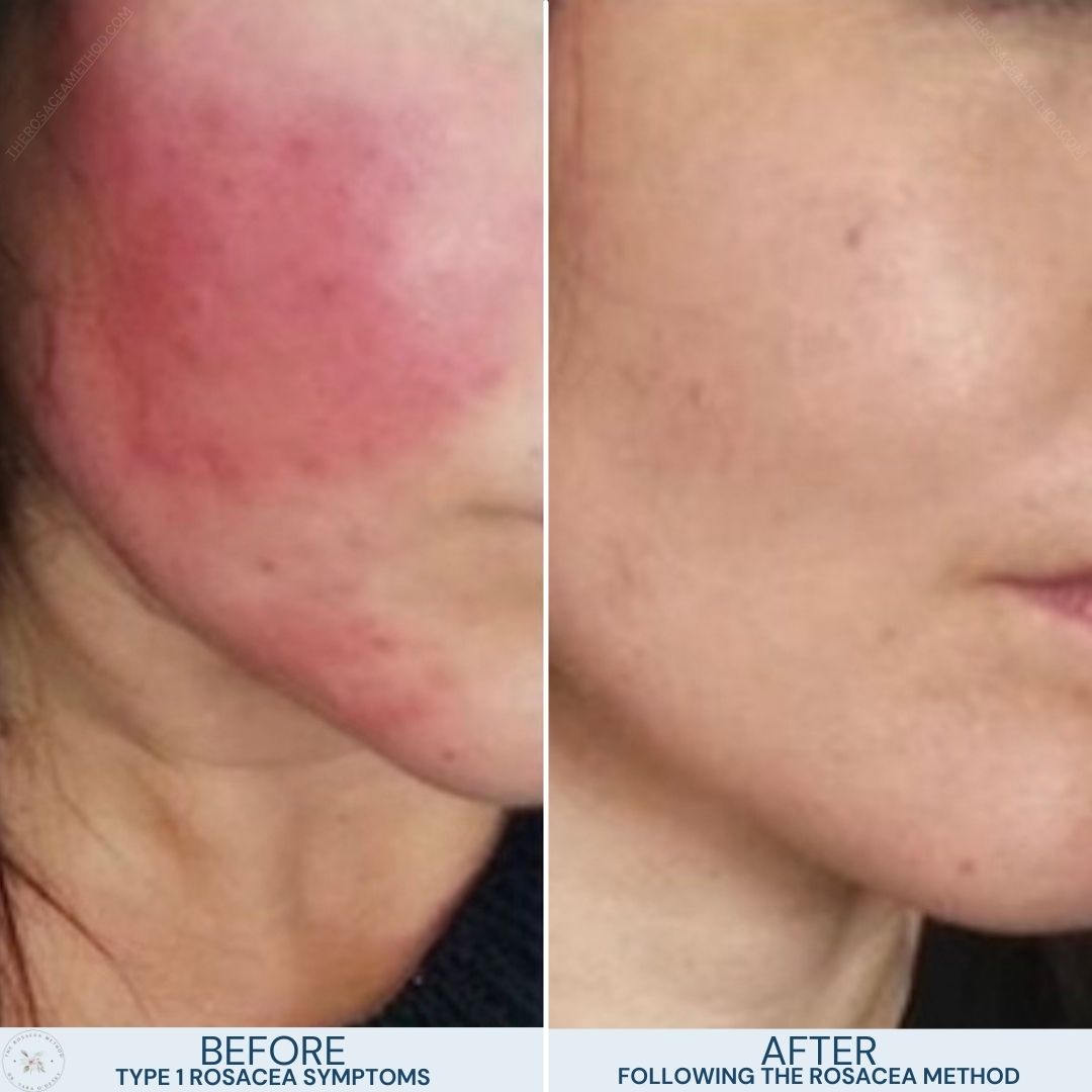 The Rosacea Method Client Transformation Results - woman with severe type 1 rosacea on the left and the same woman with a smile and the dramatic transformation of clear skin on the right
