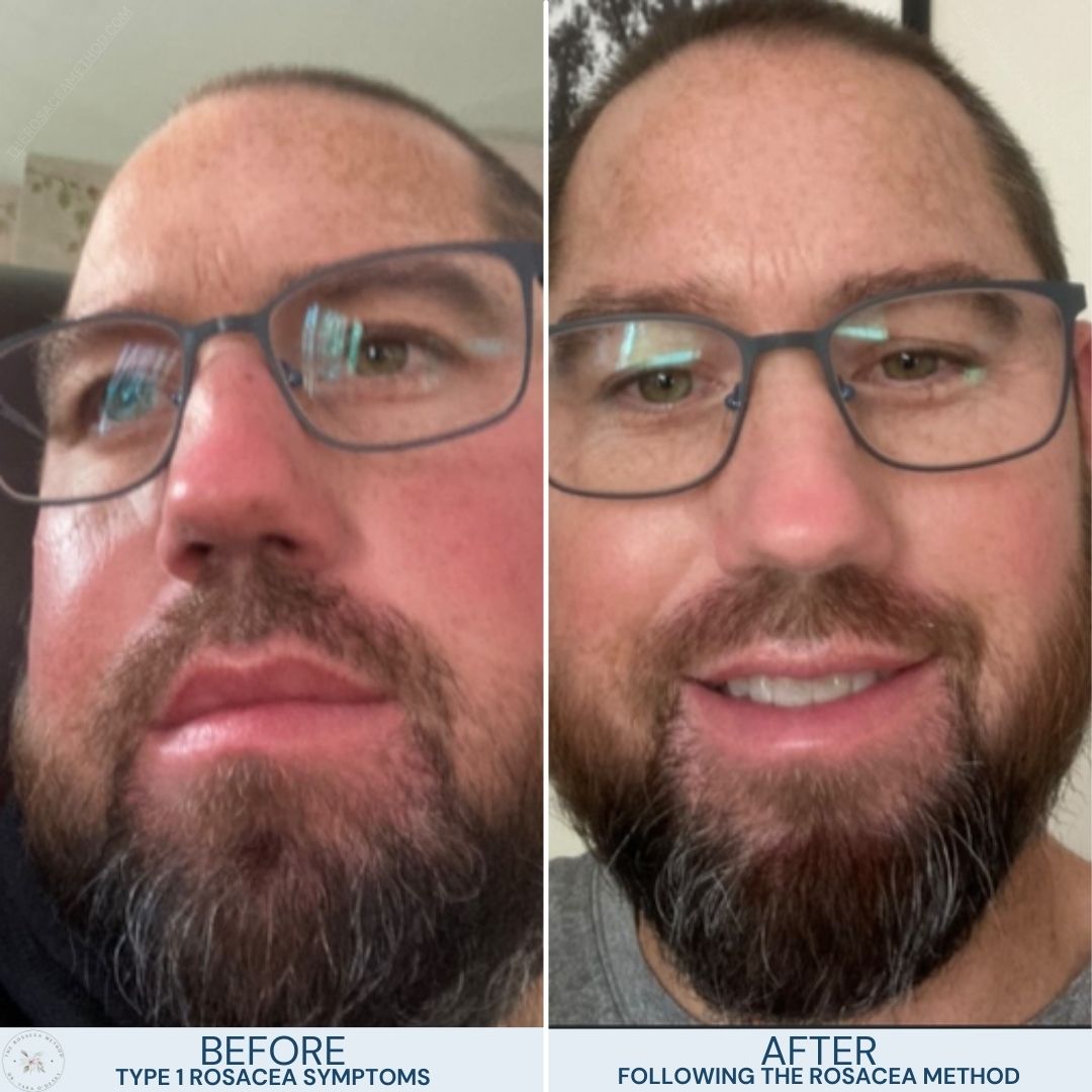 The Rosacea Method Client Transformation Results - man with mild type 1 rosacea on the left and the same man with a big smile and a beautiful transformation of clear skin on the right