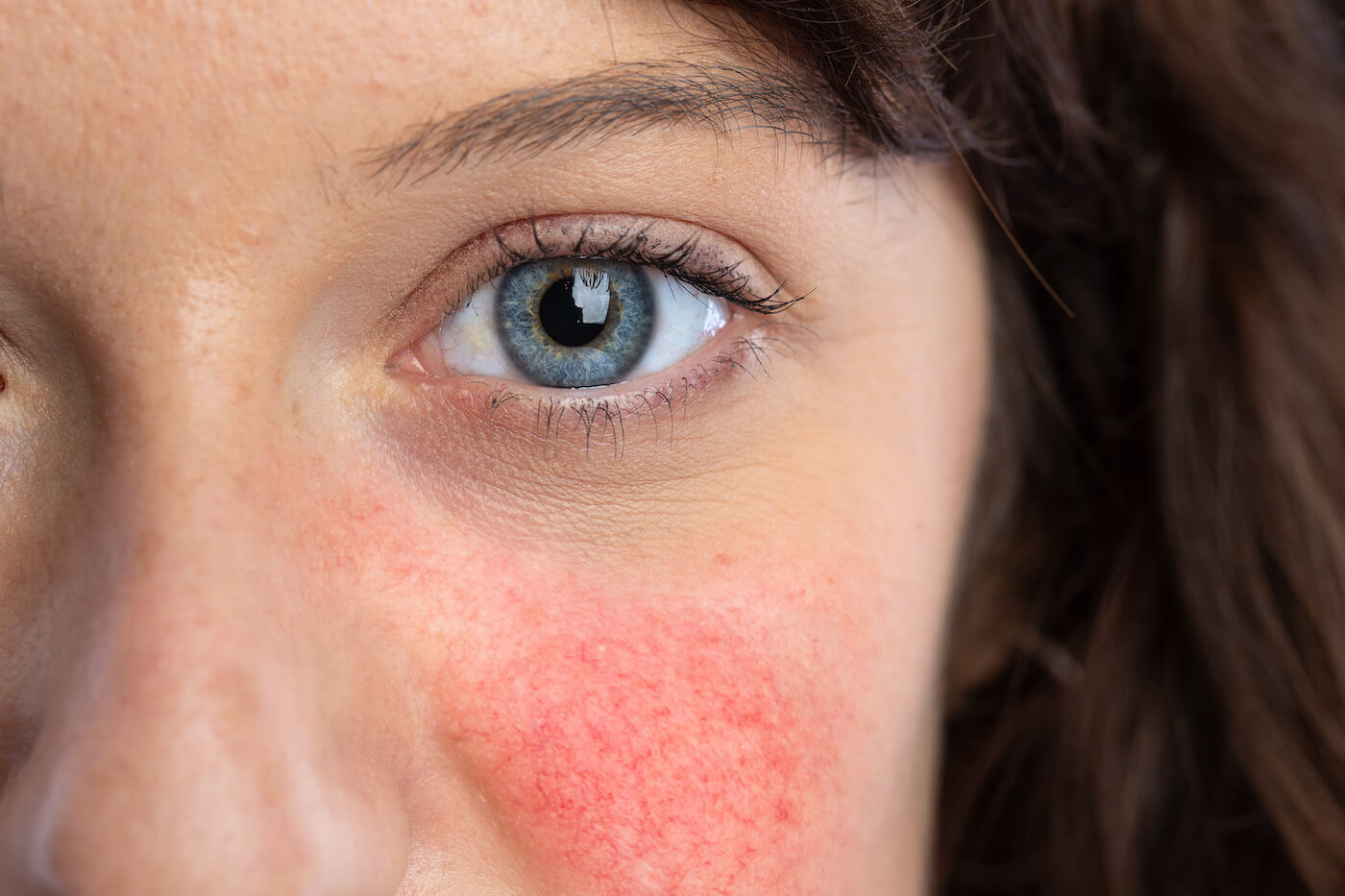 type 1 rosacea redness and visible blood vessels on woman's cheeks.