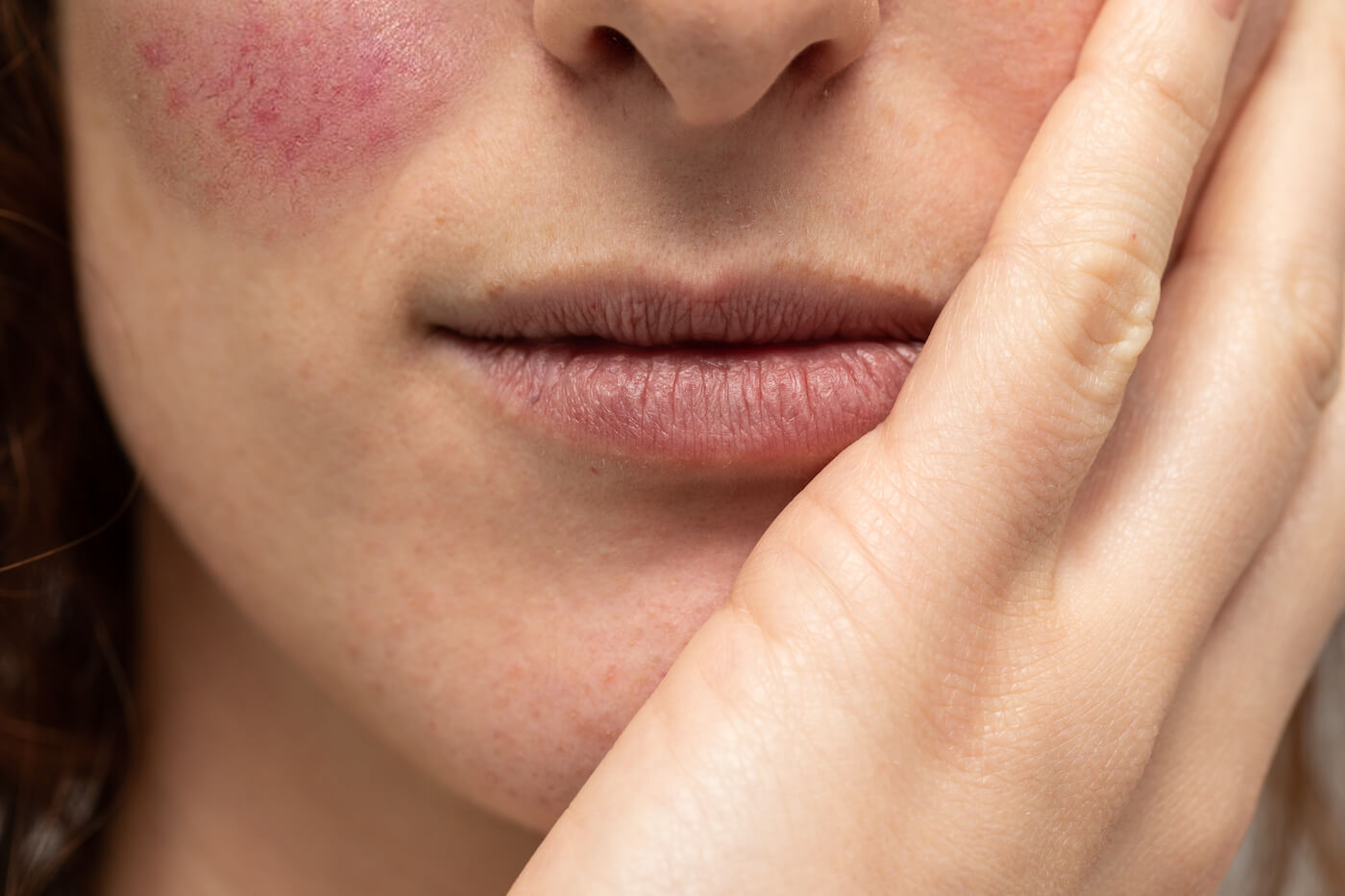 type 1 rosacea - A close up view on a caucasian woman resting her chin on hand, with visible cracked lips and type 1 rosacea