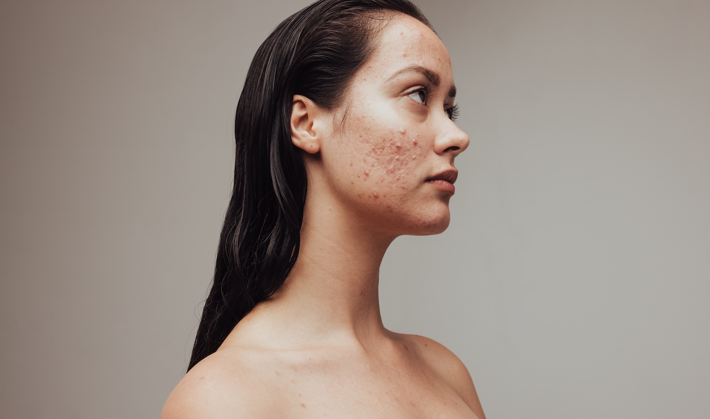 Side profile of a woman with Acne revealing it's similarity and reason for the Papulopustular Rosacea vs Acne debate. Showcasing skin condition differences for The Rosacea Method blog by Dr. Tara O'Desky