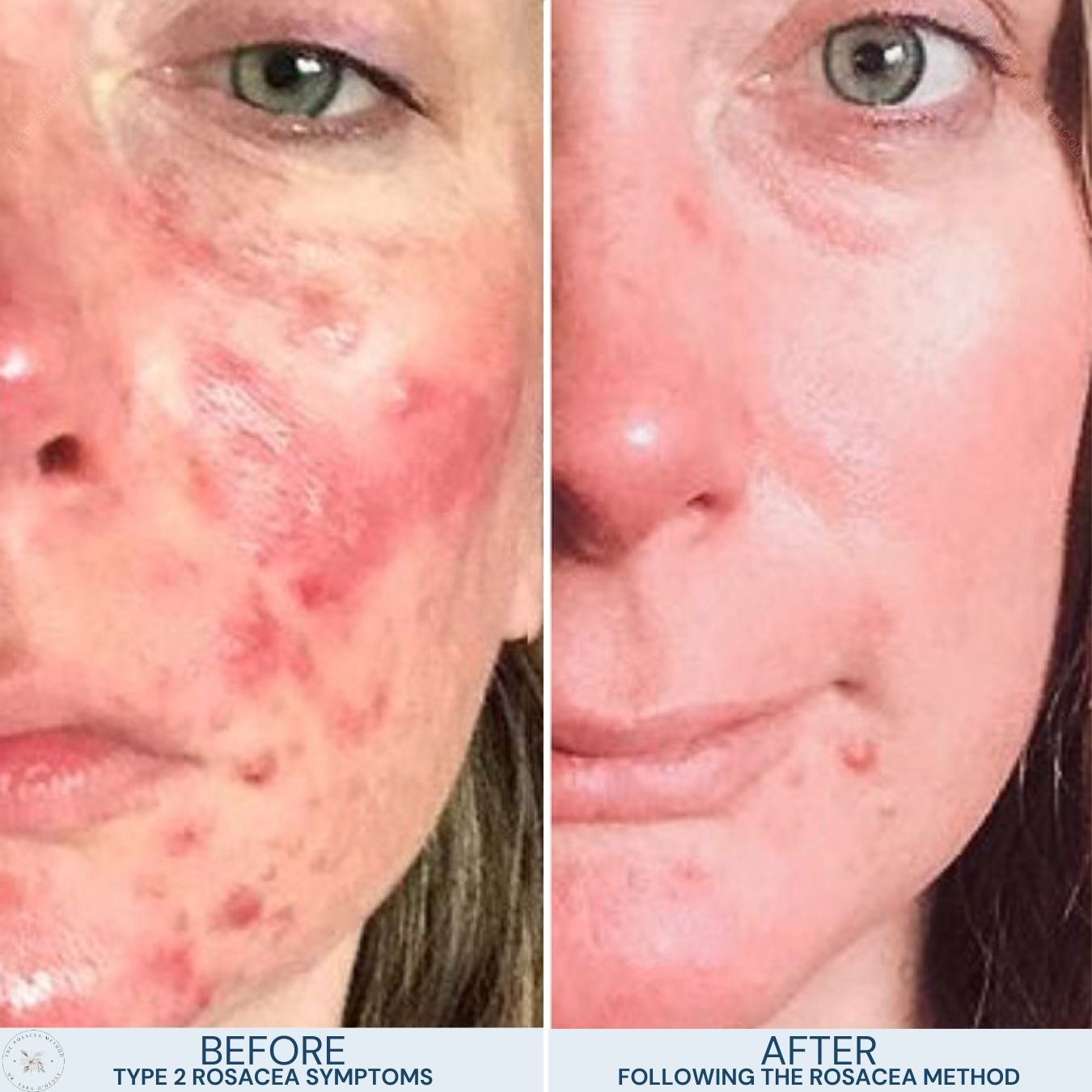 Before and after comparison of a person's face showing transformation with The Rosacea Method. The 'Before' image on the left displays prominent redness and papules typical of Type 2 Rosacea symptoms. The 'After' image on the right shows a marked reduction in inflammation and blemishes, resulting in clearer, calmer skin. These before symptoms are what makes distinguishing Papulopustular Rosacea vs acne difficult