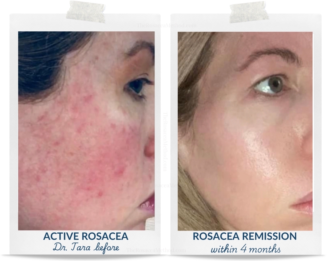 Before and after image showing Dr. Tara’s skin transformation, illustrating how I cured my ocular rosacea naturally. Left side depicts active rosacea symptoms, while the right side displays clear skin within 4 months, demonstrating significant improvement.