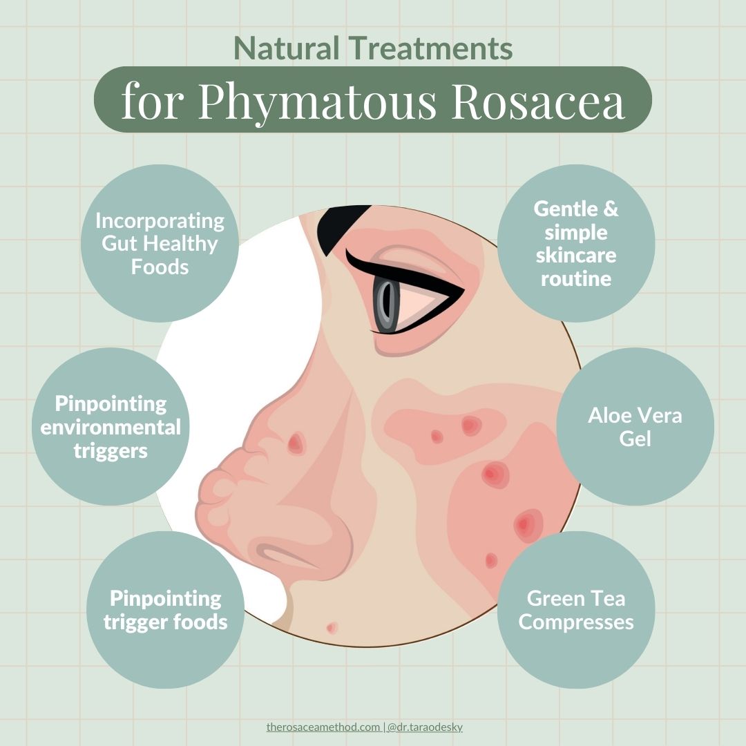 Illustration of natural treatments for Phymatous Rosacea nose and face symptoms, including gut healthy foods, skincare routine, aloe vera gel, and green tea compresses.