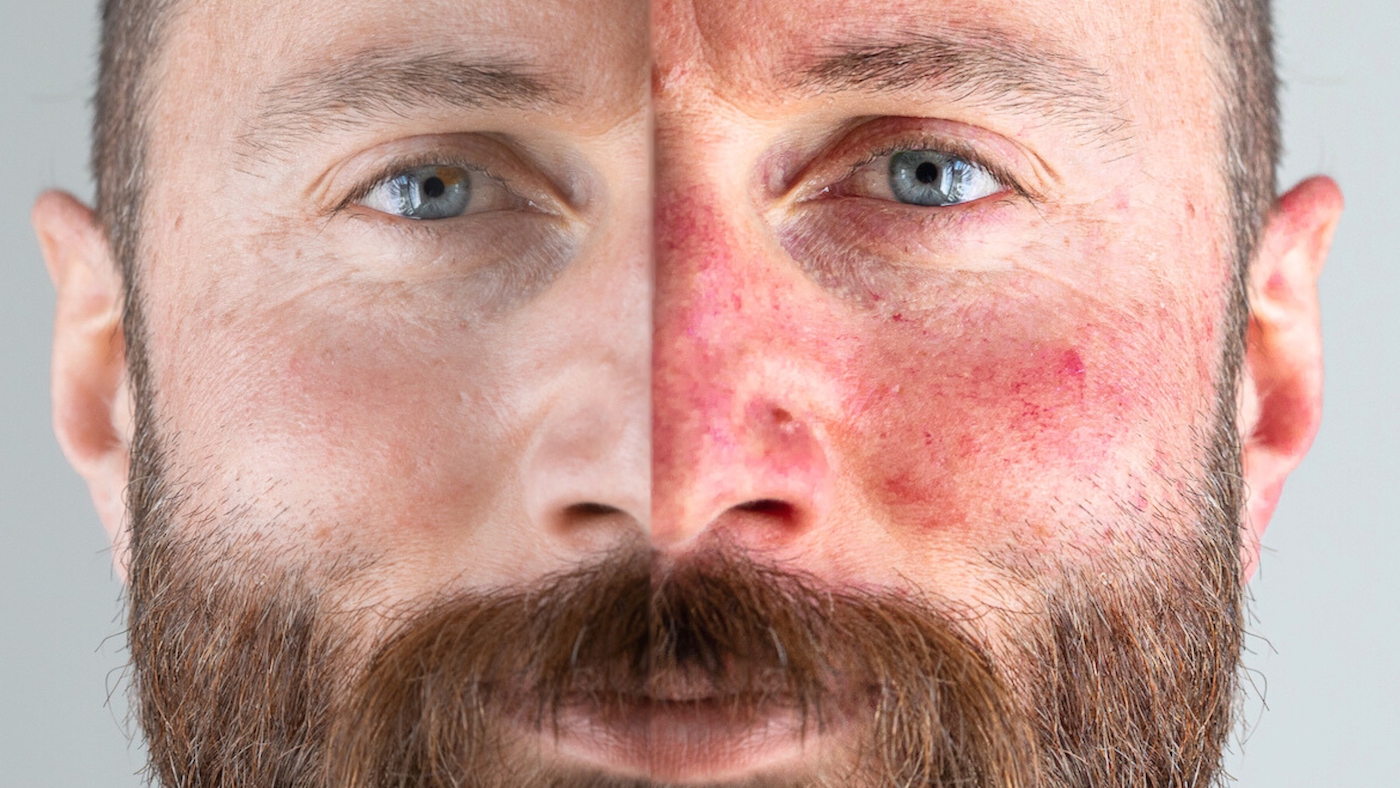 Before and after comparison of Type 3 Phymatous Rosacea Nose treatment on a male's face showing nose disfigurement and reduction of facial redness and symptoms.