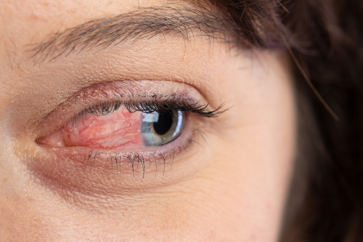 Close-up of an eye with visible redness and inflammation on the eyelid and surrounding area, highlighting the importance of finding ways to treat ocular rosacea effectively.