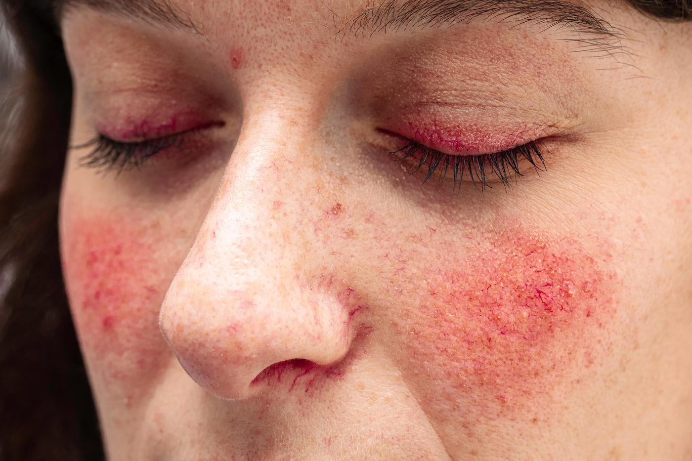 Close-up of a person with redness on their closed eyes and cheeks, looking to treat Ocular Rosacea Type 4. Showing visible signs of redness, inflammation, and small bumps on the skin.