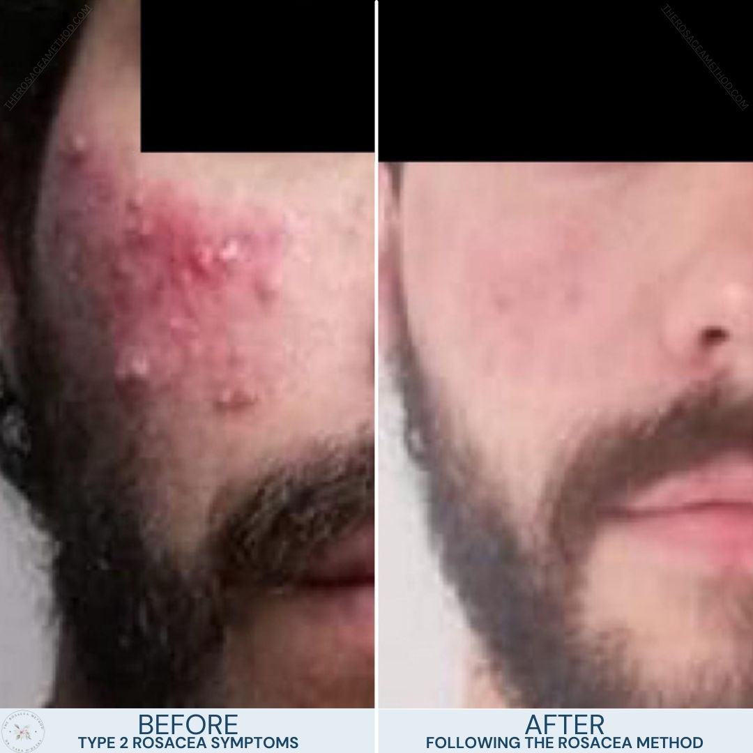 Before and after comparison of a male's cheek showing a significant reduction in redness and skin lesions after following The Rosacea Method, indicating improvement in Type 2 Papulopustular Rosacea vs Acne symptoms