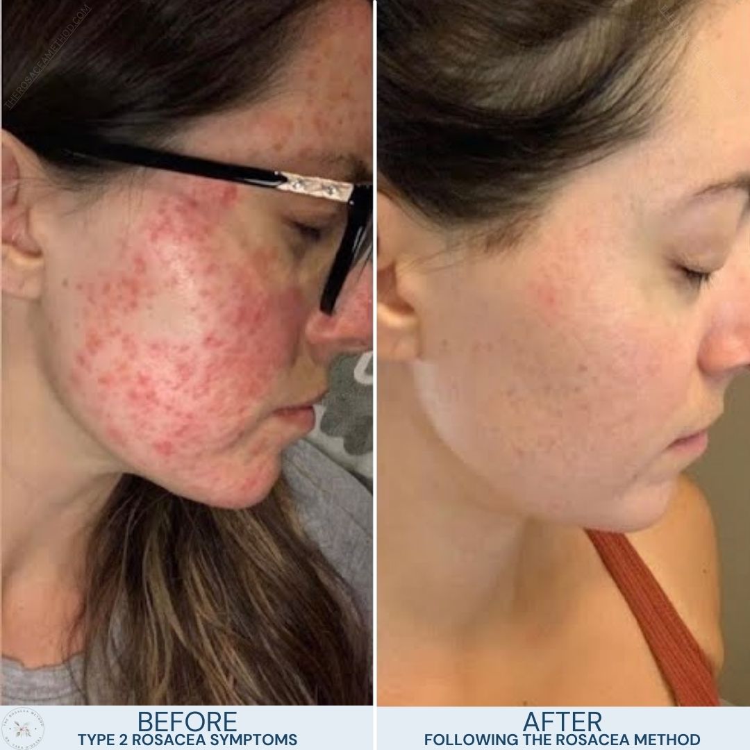 Before and after photos of a female's face demonstrating clear skin improvement with reduced redness and inflammation following The Rosacea Method, showcasing effective management of Type 2 Papulopustular Rosacea vs Acne symptoms.