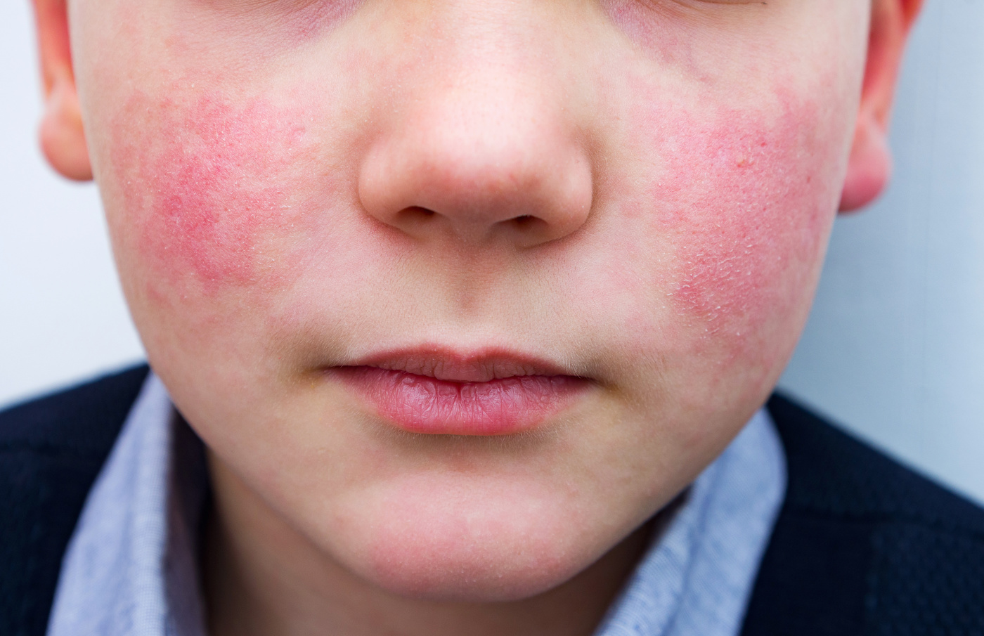 Alt text: Close-up of a child's face showing prominent red cheeks indicative of a skin condition, potentially requiring careful evaluation and management strategies as part of a comprehensive approach to treating skin redness in children.