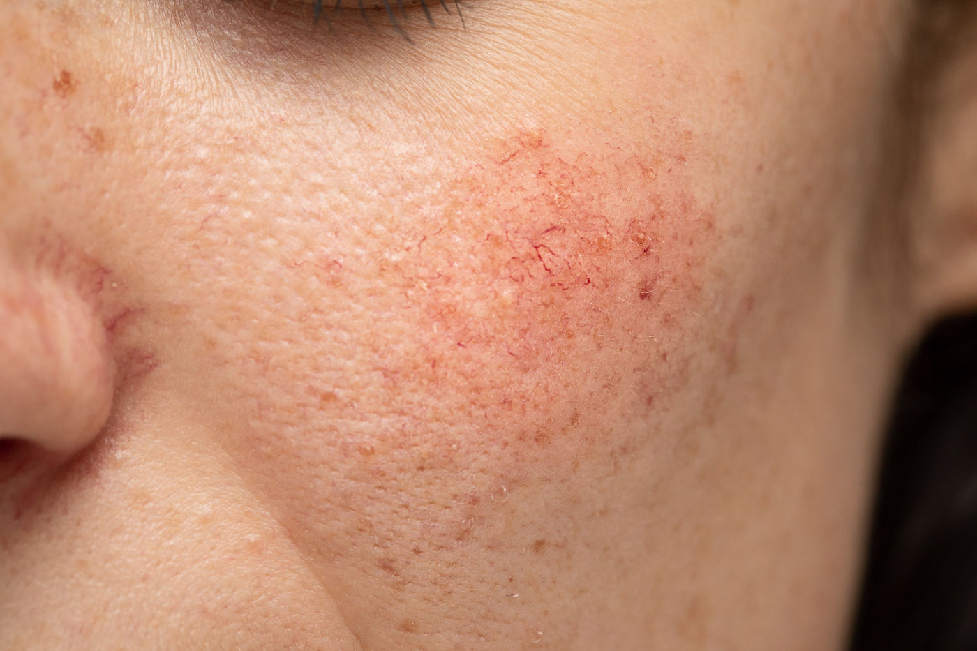 Detailed close-up of red cheeks with visible signs of rosacea, highlighting the textured skin condition that necessitates a focused approach to managing rosacea symptoms.
