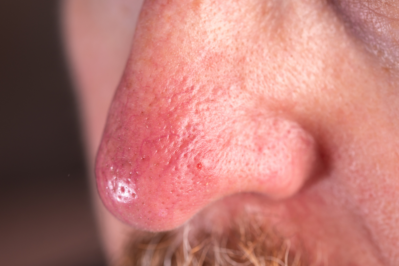 Close-up of a Type 3 Phymatous Rosacea-affected nose with visible pores and redness characteristic of the condition.