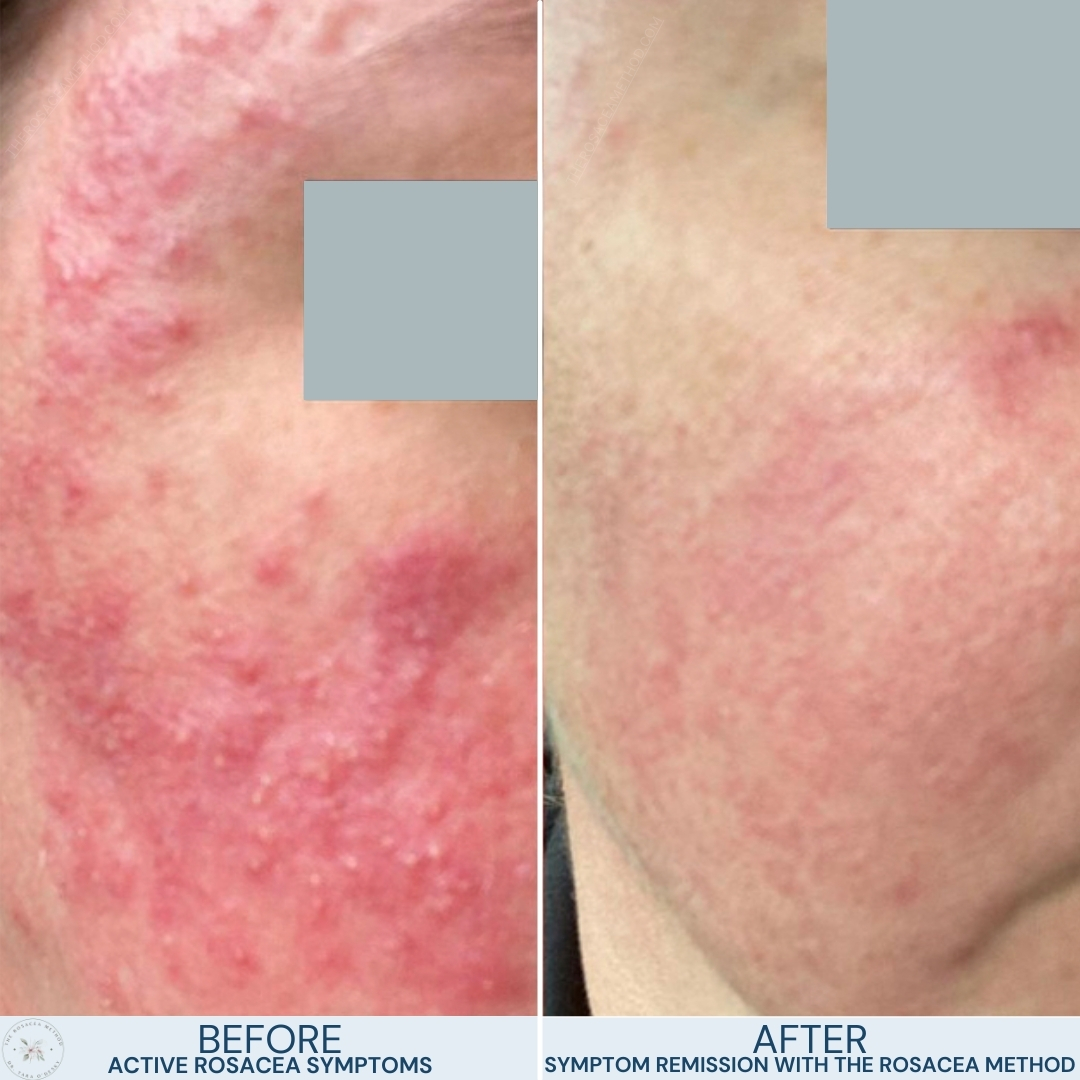 Before and after comparison of a close-up of cheek skin showing active acne-like rosacea symptoms and symptom remission using the Rosacea Method to heal rosacea with diet.