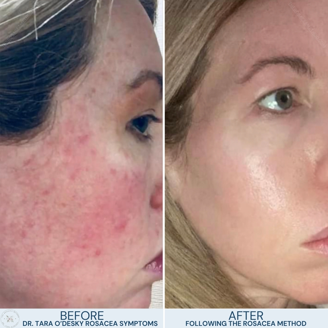 Before and after photos showing significant improvement in Dr. Tara O'Desky facial skin from severe rosacea to clear skin, demonstrating how to heal rosacea with diet.