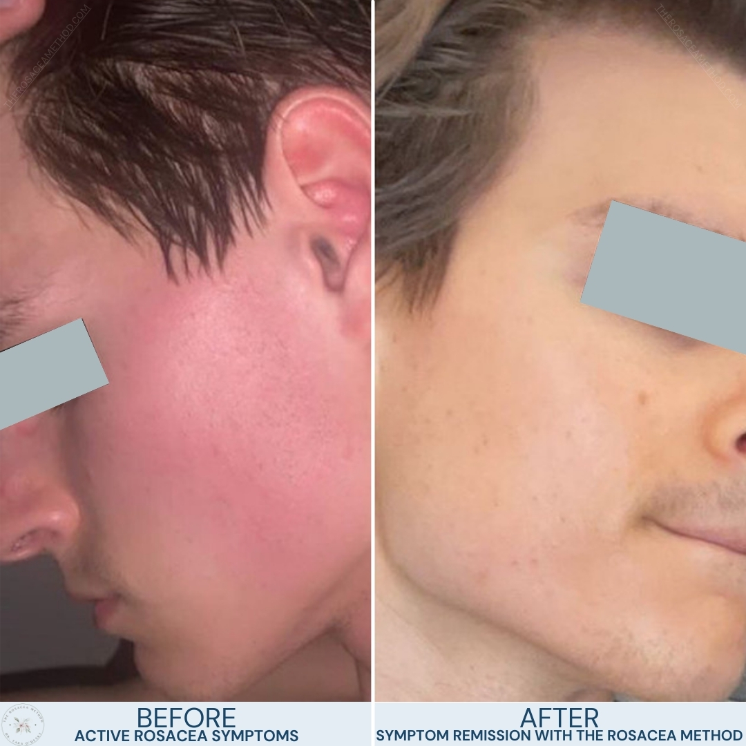 Before and after profile views of a young male's face showing a clear transition from active rosacea symptoms to symptom remission through dietary changes that heal rosacea with diet.