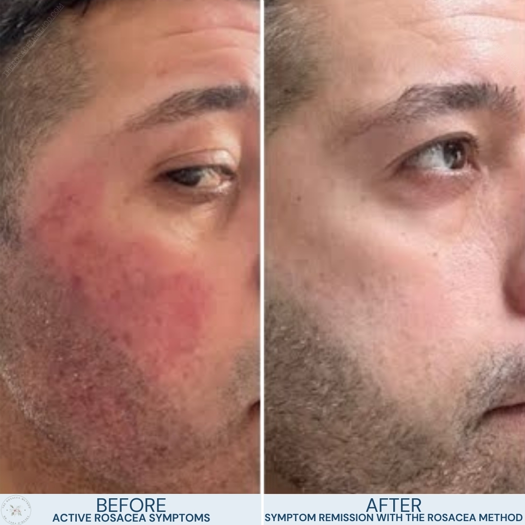 Before and after images of a man's face showing the efficacy of dietary changes to heal rosacea with diet, transitioning from intense redness to clearer skin.
