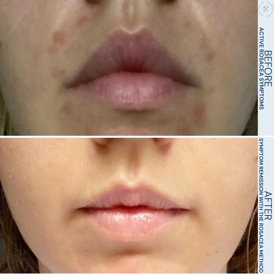 Before and after comparison of a female's lower face showing significant improvement in skin condition from active rosacea symptoms to symptom remission, demonstrating how to heal rosacea with diet.