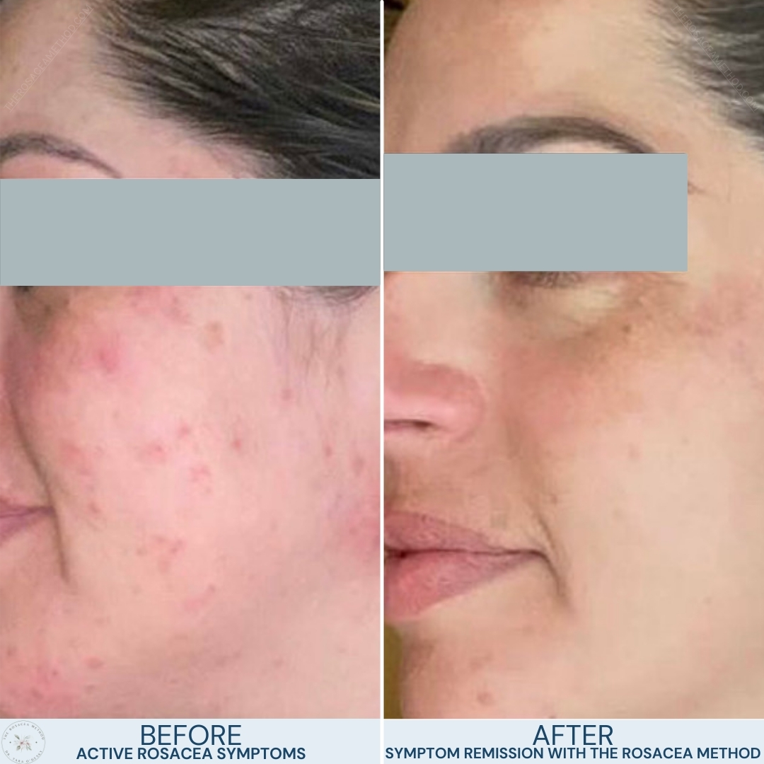 Before and after images of a woman's face showing remarkable improvement in rosacea symptoms, highlighting how to heal rosacea with diet using the Rosacea Method.