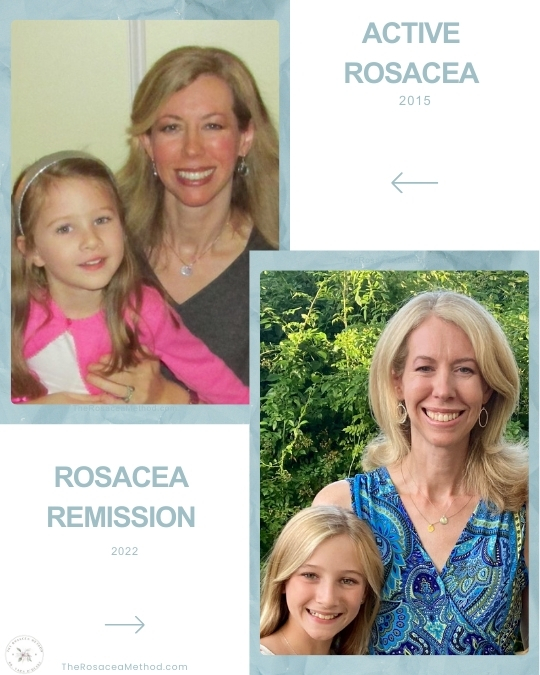 Dr. Tara's before and after images showing the transformation from active rosacea in 2015 to rosacea remission in 2022, highlighting the impact of addressing gluten and rosacea.