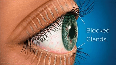 Illustration showing blocked glands in the eye, demonstrating how to make a warm compress for eyes, which helps unclog glands and provide relief for conditions like ocular rosacea.