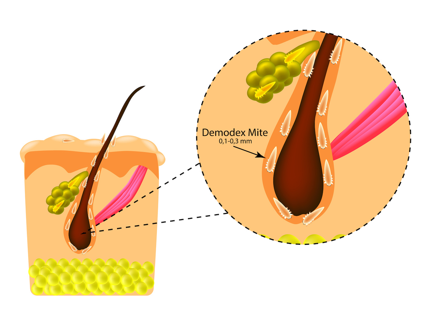 A vector illustration showing Demodex mites in the sebaceous glands of a hair follicle, highlighting their presence in eyelashes and their potential role in skin conditions like rosacea.