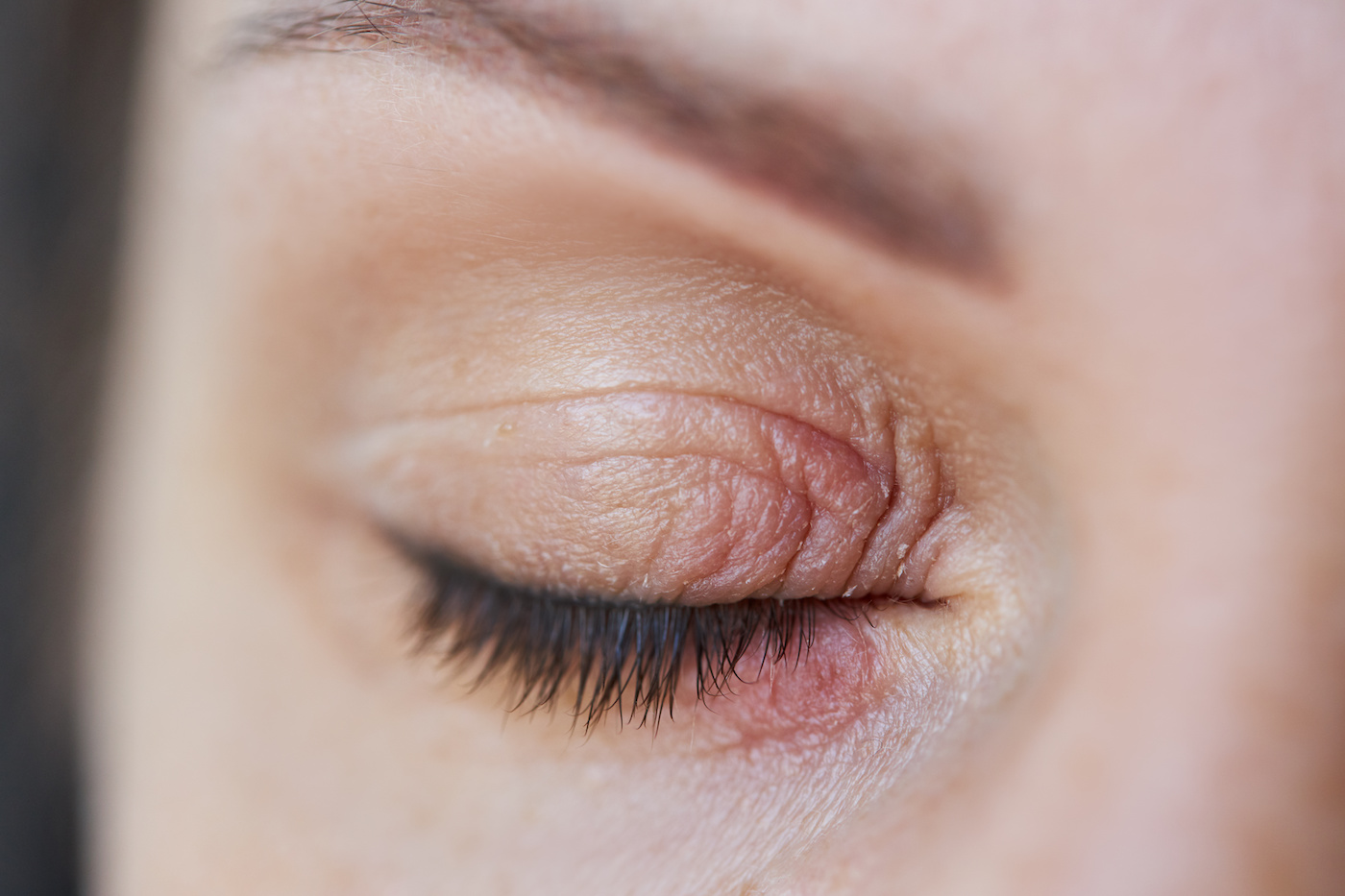 A close-up of a swollen and peeling eyelid with visible redness, a common symptom linked to Demodex mites in eyelashes and their impact on sensitive rosacea skin.