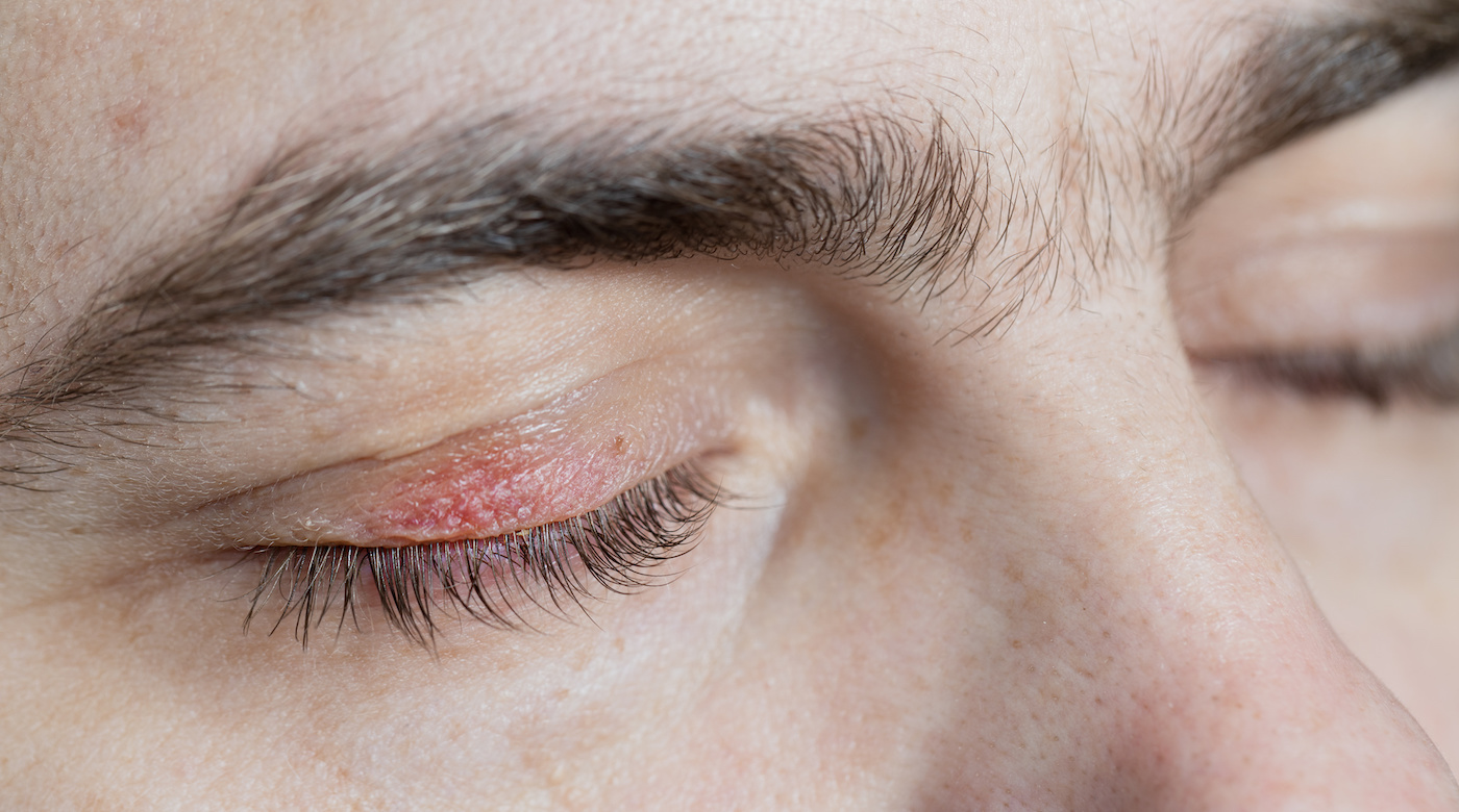 Close-up of a male with swollen eyelid and redness caused by blepharitis, a condition commonly associated with Demodex mites in eyelashes.