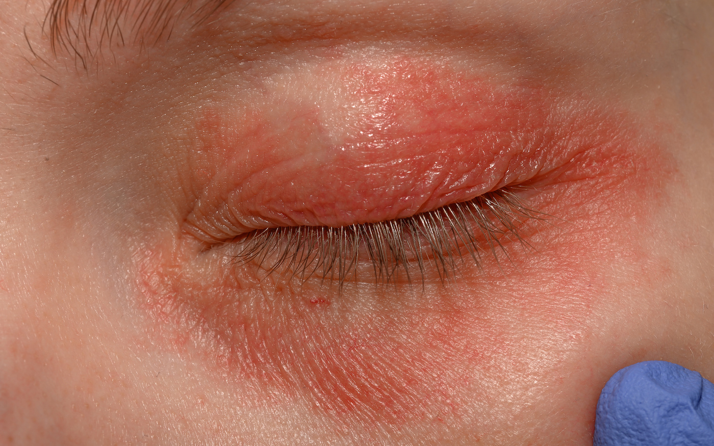 Close-up of a severe case of ocular rosacea and blepharitis, showing red, inflamed skin around the eyelid and lash area, commonly associated with Demodex mites in eyelashes.
