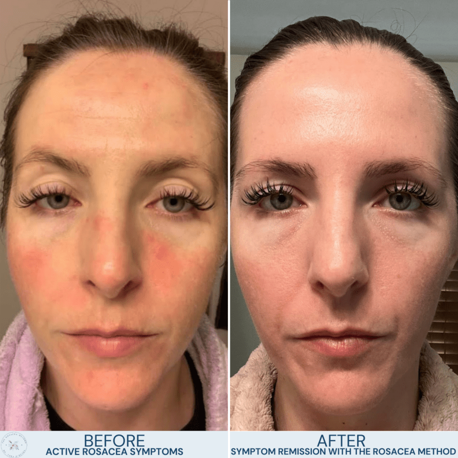 Before-and-after results of a client who achieved clearer skin through natural healing for rosacea with The Rosacea Method by Dr. Tara O’Desky, reducing redness naturally.