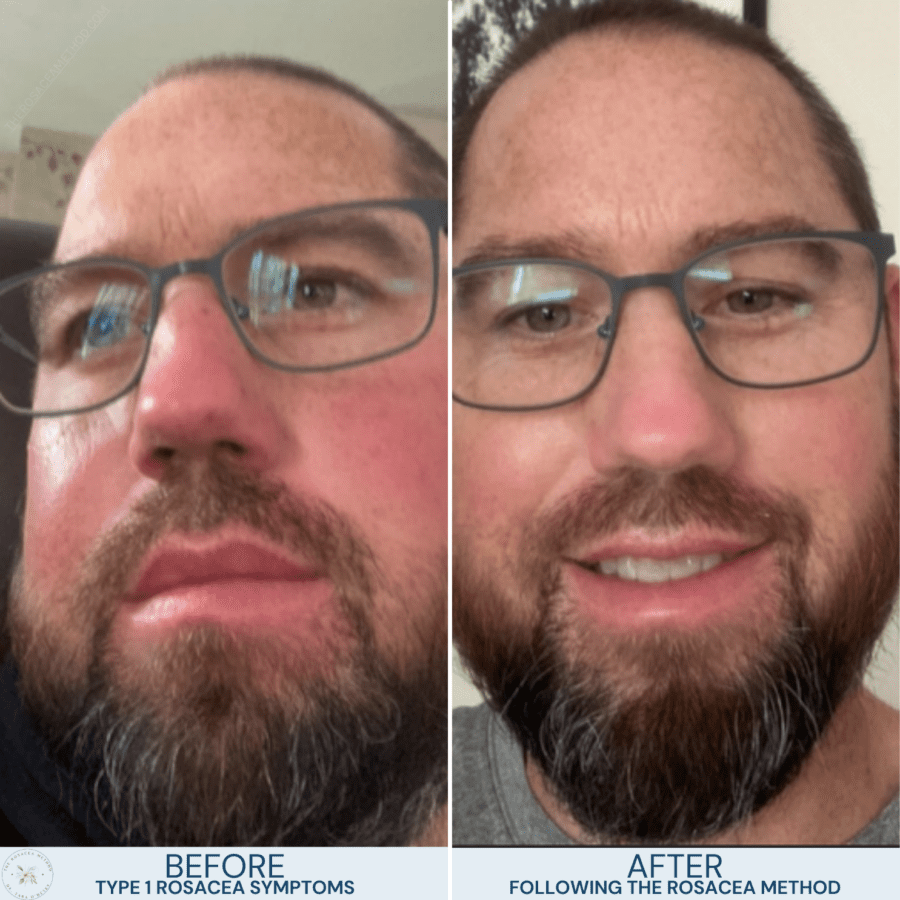  Before-and-after results of a client using Dr. Tara O’Desky’s natural healing for rosacea program, showing reduced redness and inflammation.
