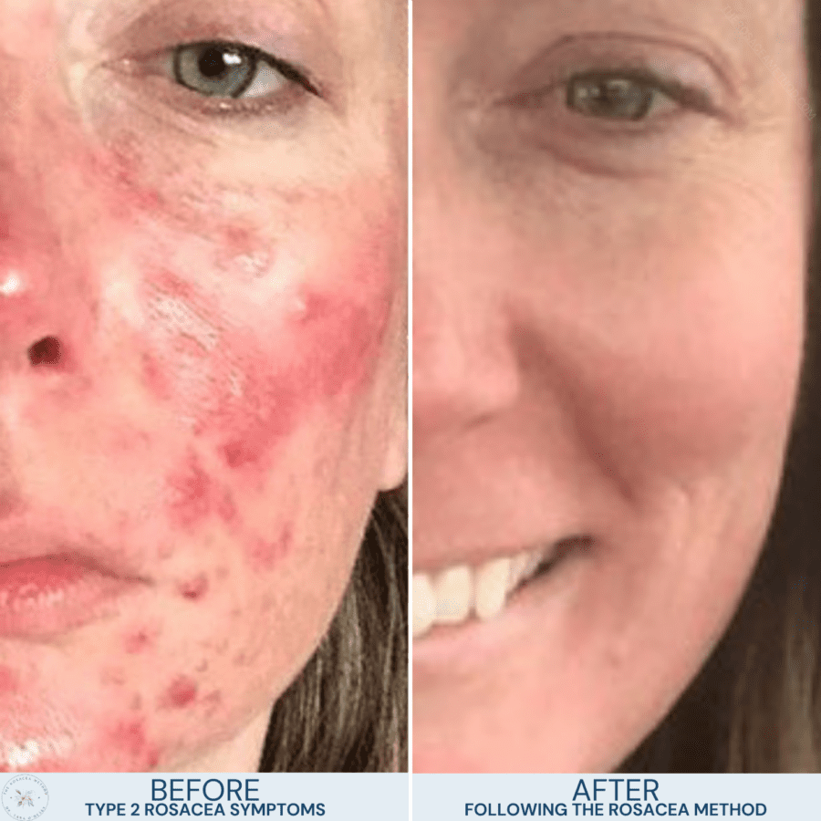 Side-by-side comparison of a natural healing for rosacea client before and after completing Dr. Tara O’Desky’s root-cause healing program.
