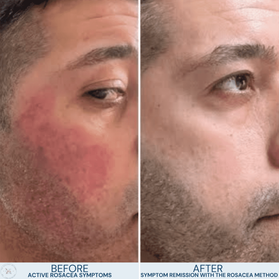 A client’s natural healing for rosacea transformation after addressing gut health and inflammation with Dr. Tara O’Desky’s The Rosacea Method.