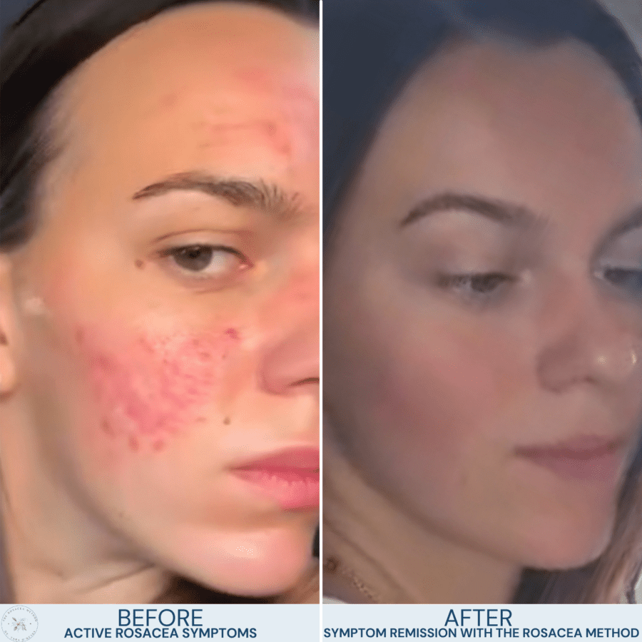 A client’s holistic rosacea journey showing reduced redness and smoother skin after restoring gut health with The Rosacea Method.