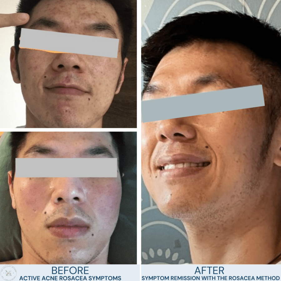 A client’s holistic rosacea improvement after following The Rosacea Method, clearing their skin naturally without medications.