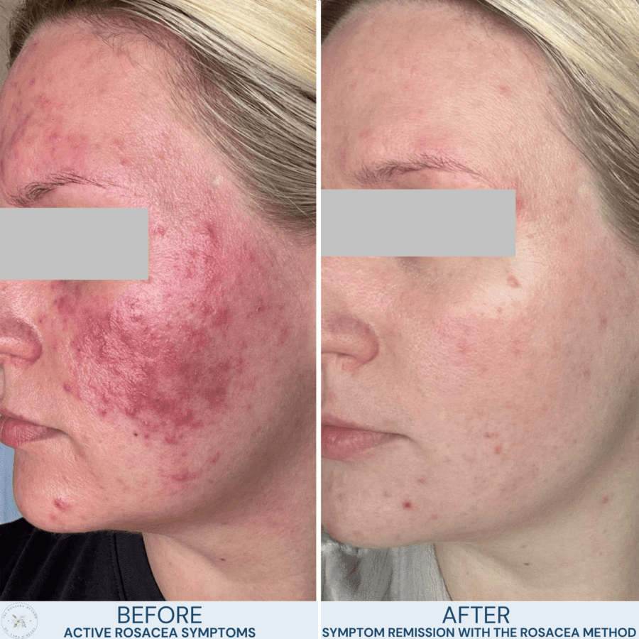 Before-and-after results of a client using Dr. Tara O’Desky’s holistic rosacea healing program, showing reduced redness and inflammation.
